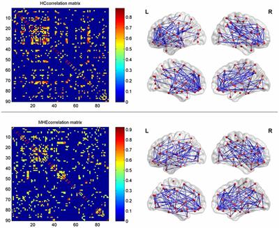 Altered Topological Properties of Gray Matter Structural Covariance Networks in Minimal Hepatic Encephalopathy